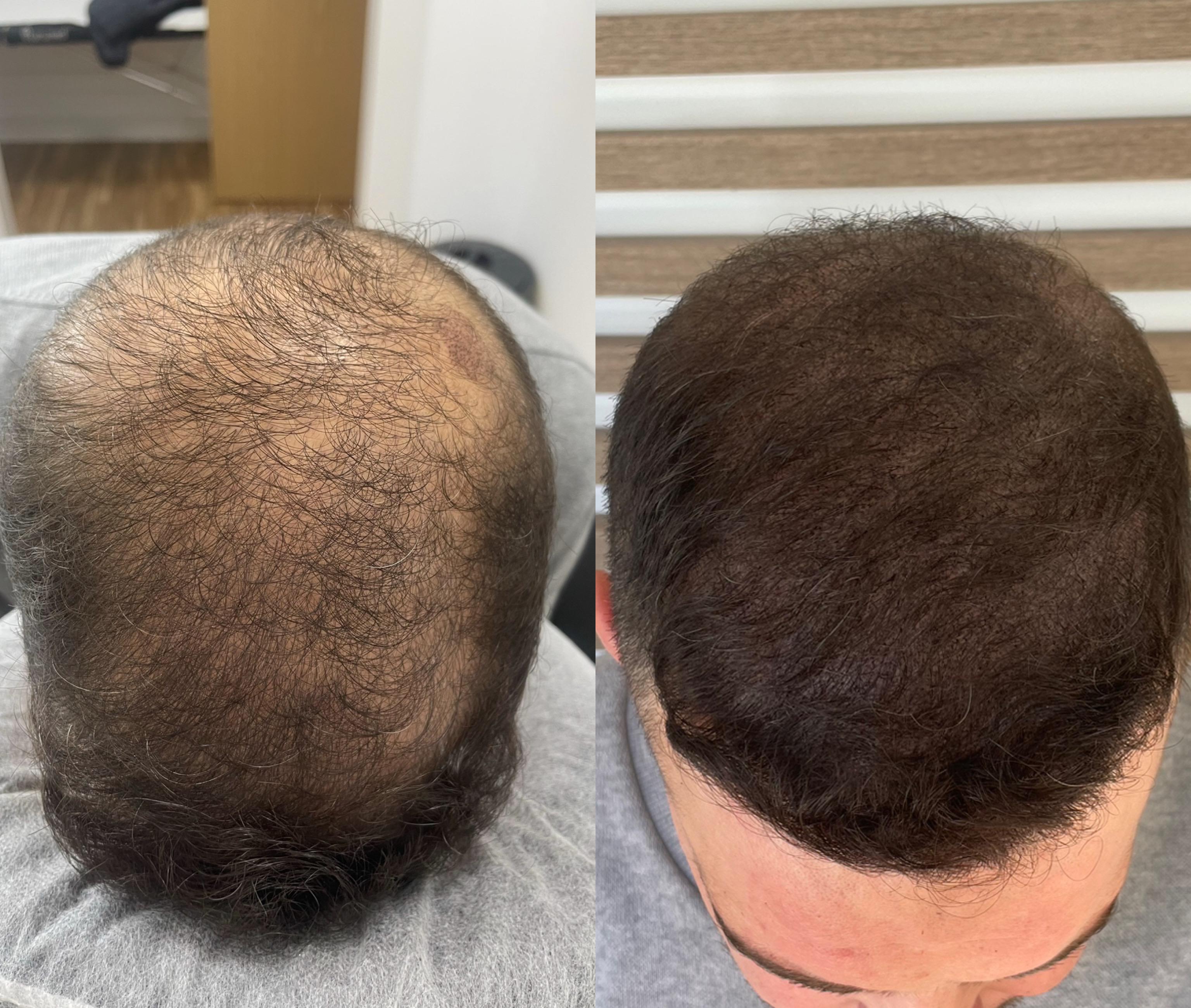 Tratamiento de densidad capilar con SMP