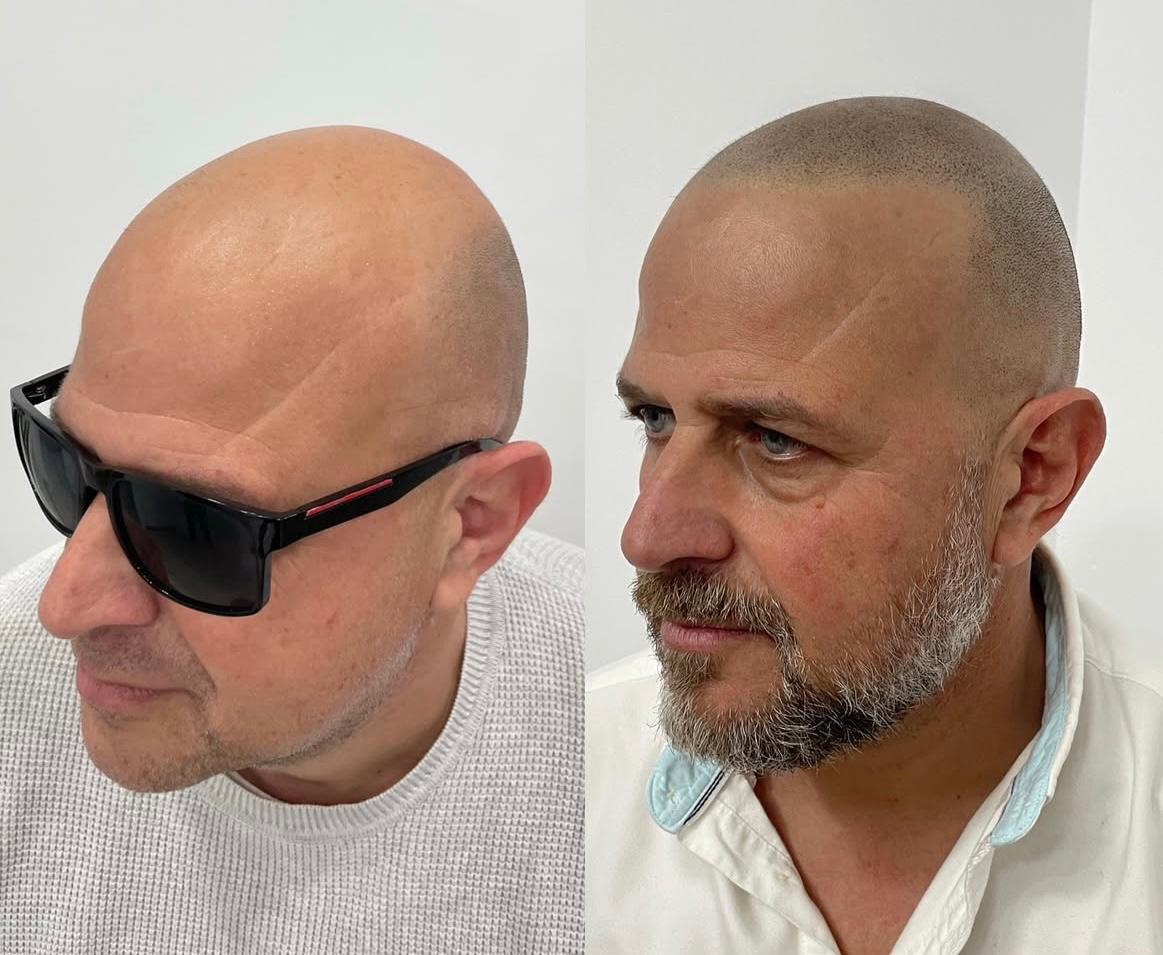 Micropigmentación capilar SMP en Sevilla